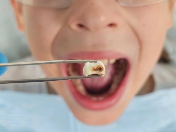 Best Emergency Dentist for Knocked-Out Tooth in Floydada, TX